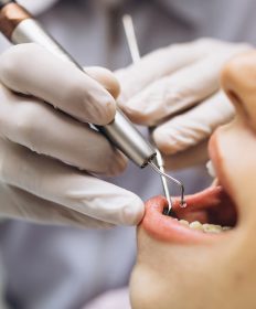 Jak wygląda leczenie paradontozy u periodontologa – krok po kroku